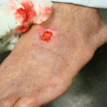 Penyakit Arteri Perifer Bisa Picu Sensasi Terbakar di Kaki